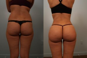 Brazilian Butt Lift