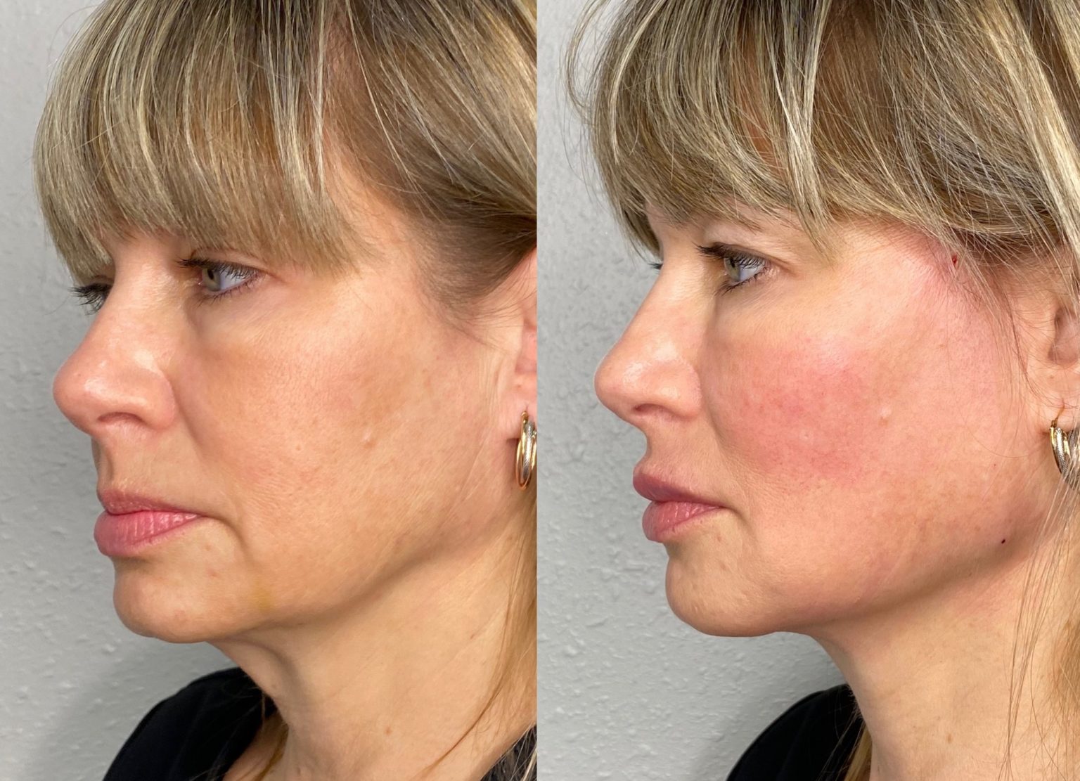 PDO Jawline / Jowl Thread Lift in Clearwater, Florida