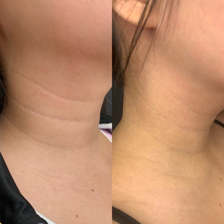 Neck fillers last up to two years