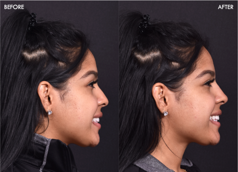 Nose job under local anaesthetic