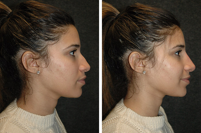 Non Surgical Nose Job 5