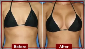 PDO Breast Lift 2