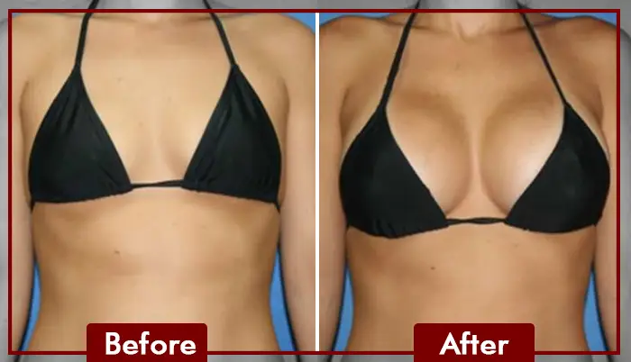 PDO Breast Lift 2