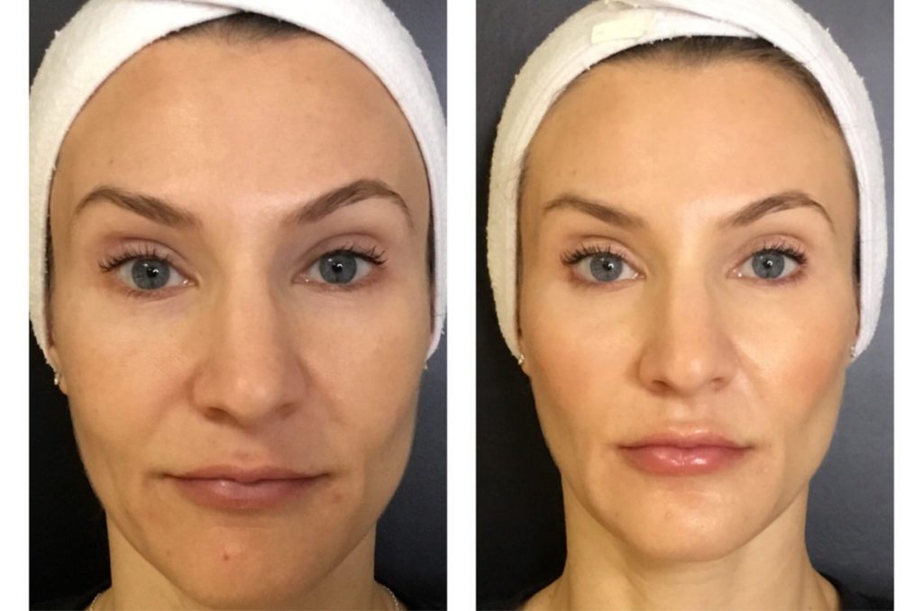 dermal fillers in clearwater fl, nasolabial folds, fda approved injection