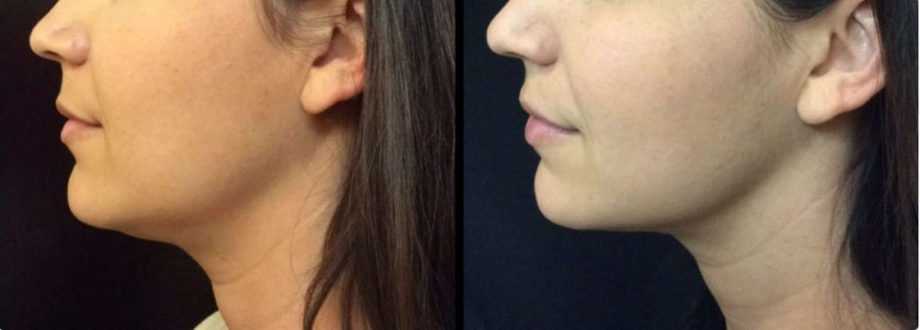 Kybella Double Chin