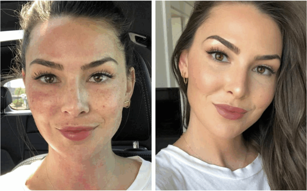 lux injectables results before and after