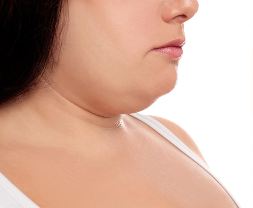 who-is-a-good-candidate-for-kybella