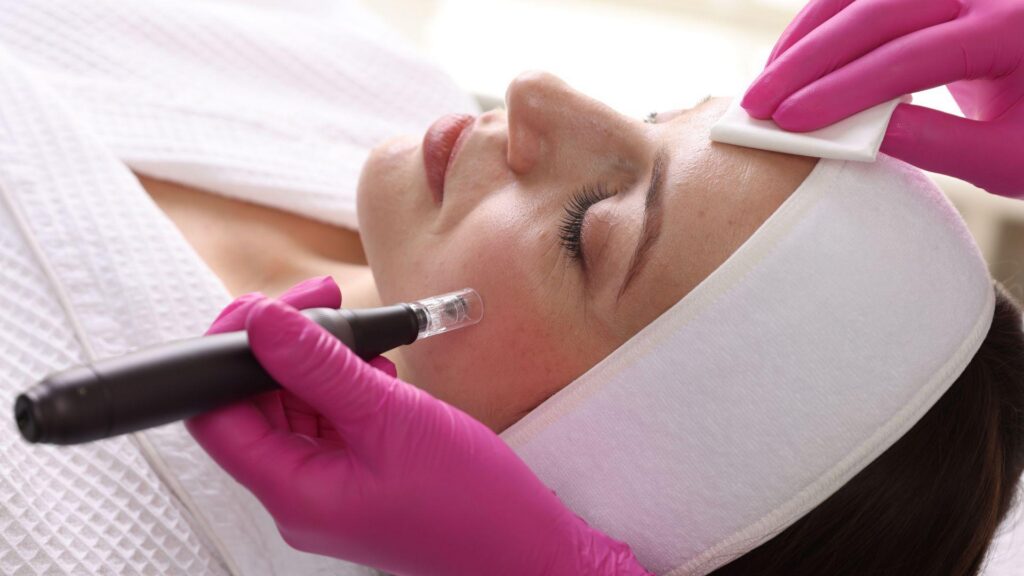 Microneedling Treatment in Clearwater, FL – Glow & Renew Skin