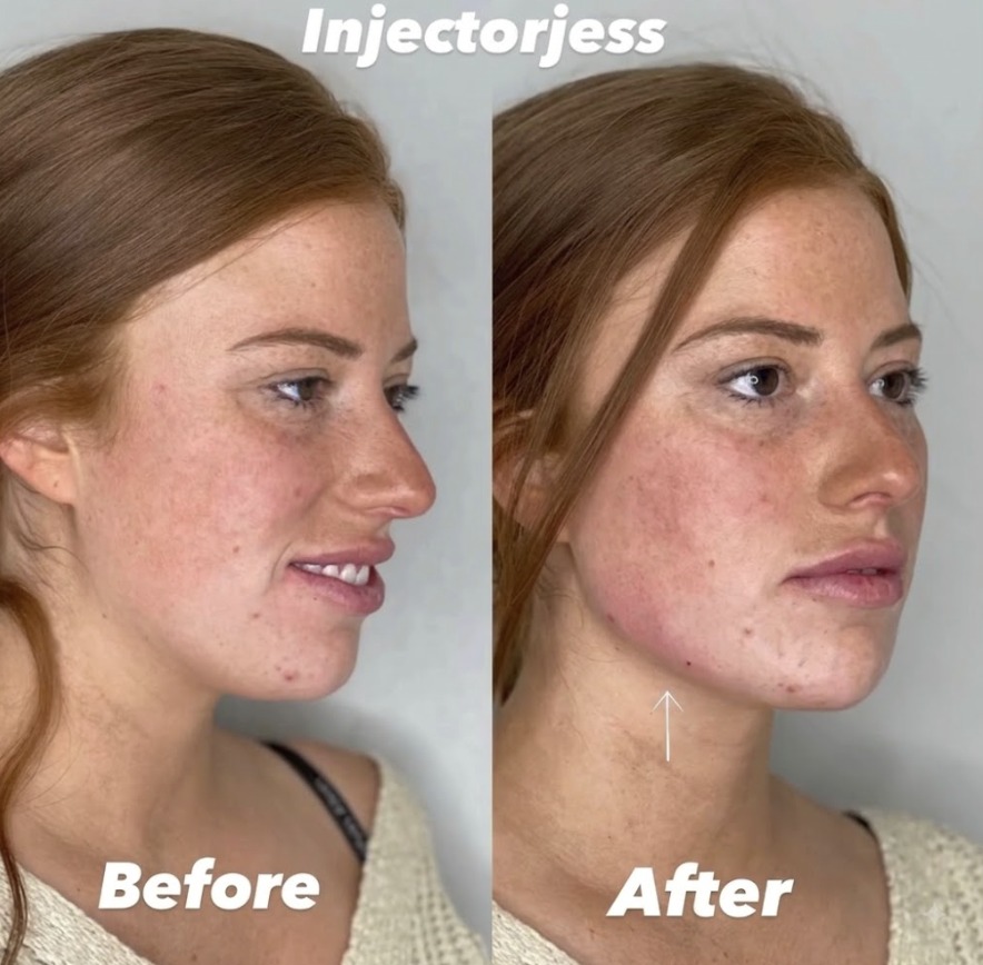 What Jawline Filler Before and After Results May Look Like