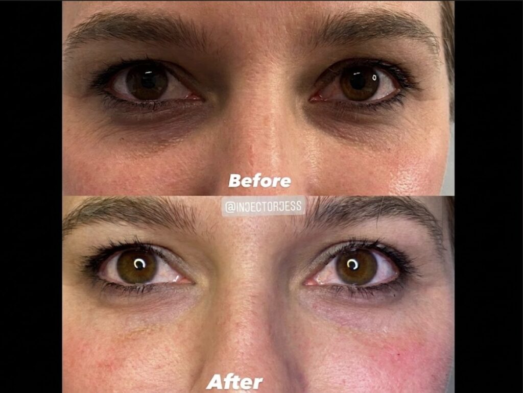 What Under Eye Concerns Can Filler Improve