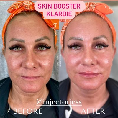 Skin Booster